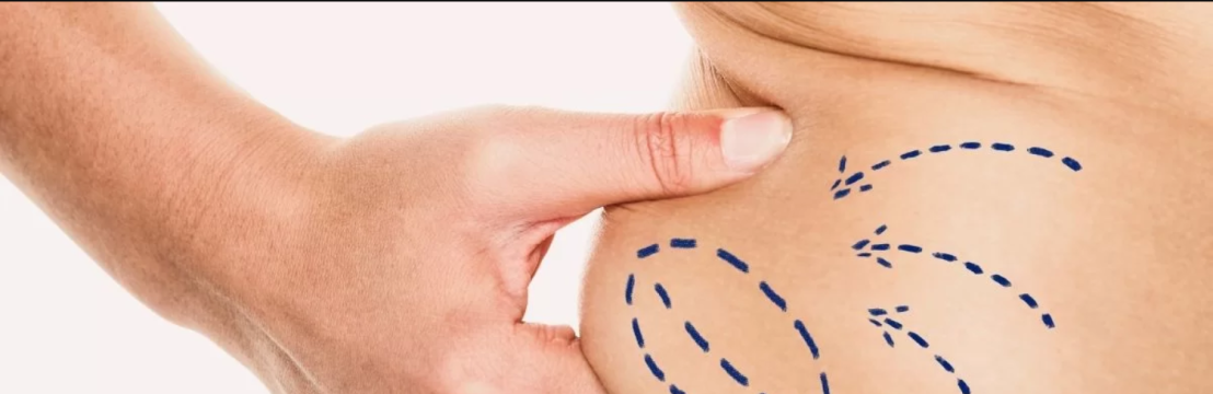 Liposuction Surgery
