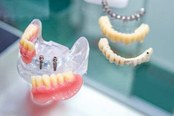 Dental implants Newry