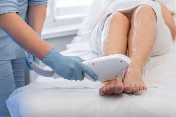 laser hair removal in Ipswich